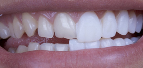 Непрямая реставрация зубов