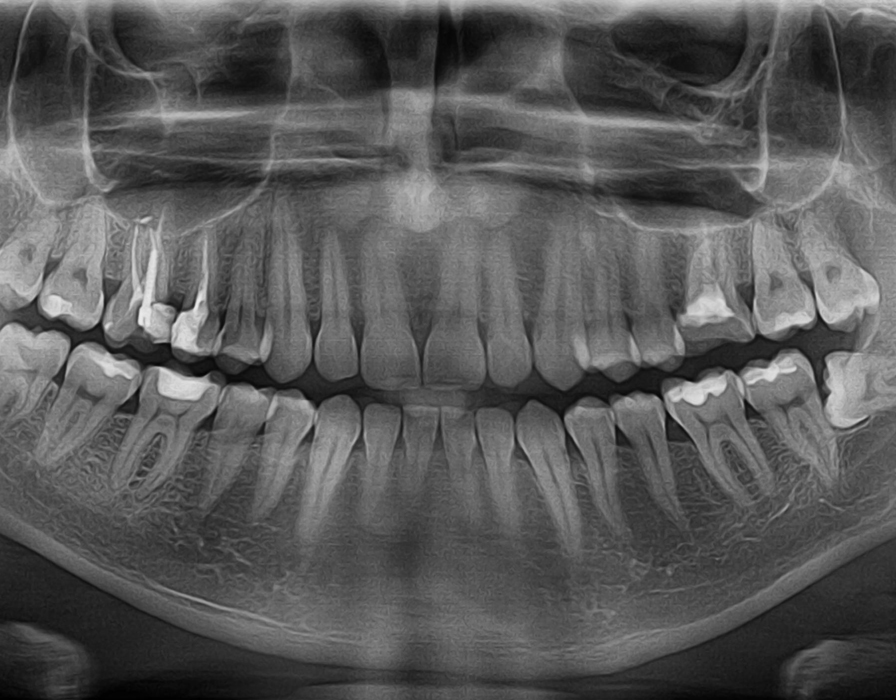 Панорамный снимок зубов Томск Макарова Импланты Nobel Biocare Томск Тимофеева