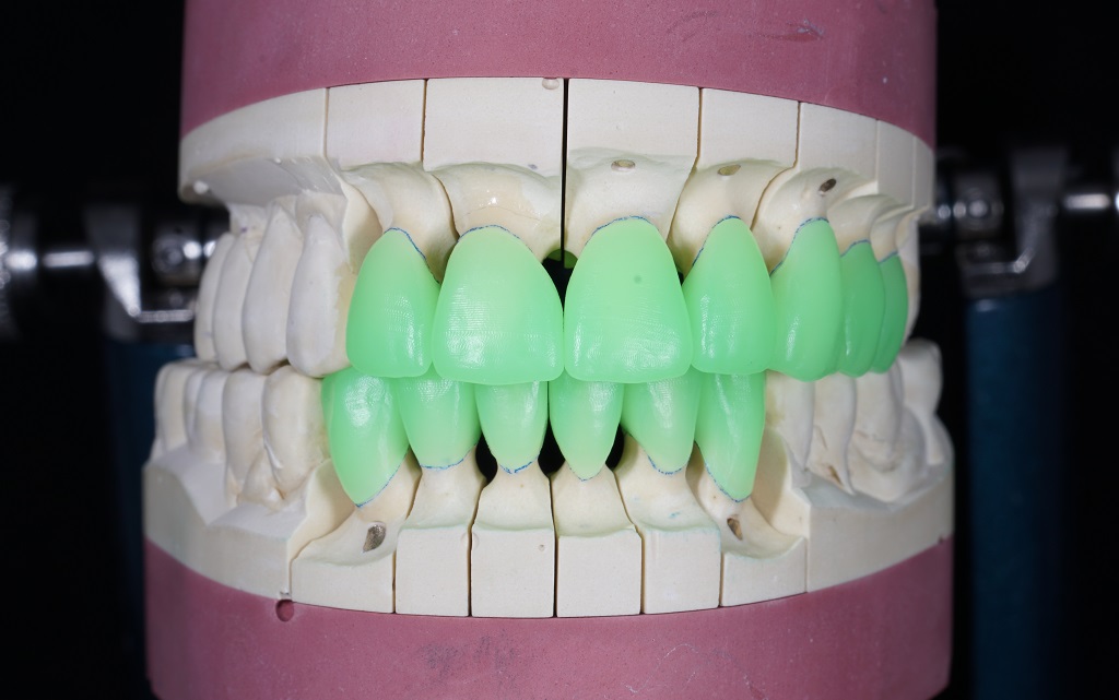 Коронки Emax на циркониевой дуге. Экспертная стоматология. Протезист москва