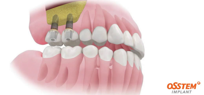 зубные импланты osstem