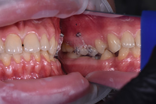 ортодонтические микроимпланты
