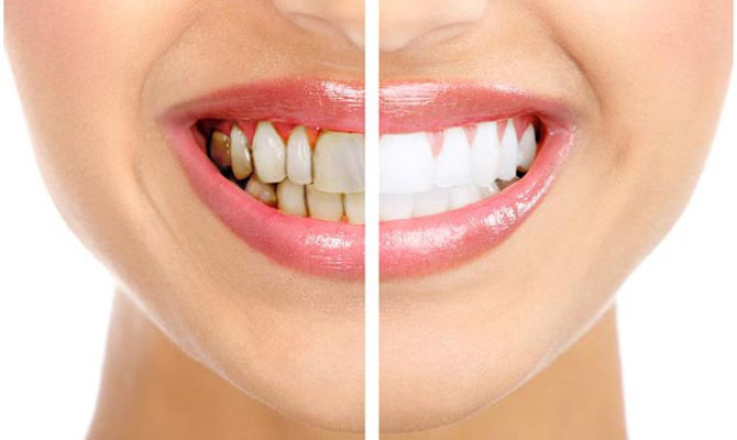Гигиена зубов и полости рта