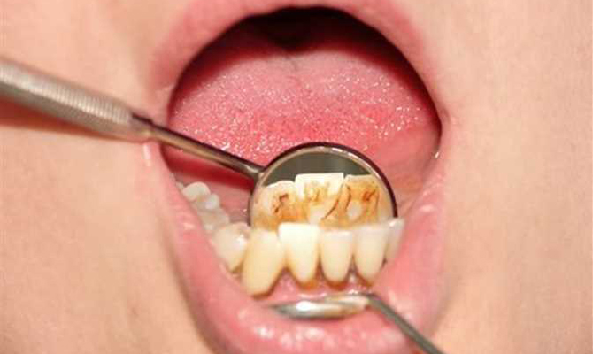 Удаление зубного камня Томск Мостовой 1-й стоматологии в томске отзывы пациентов
