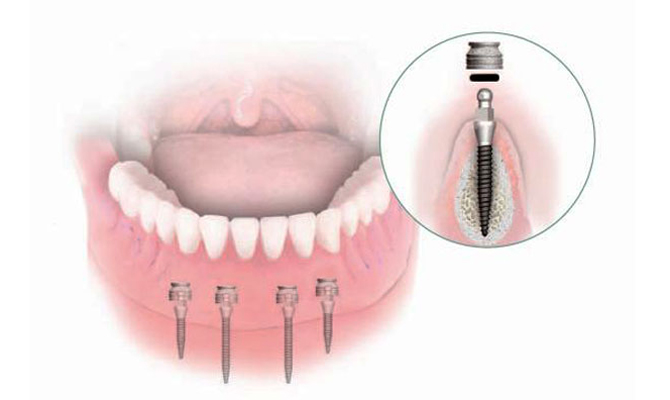 зубной мини-имплант
