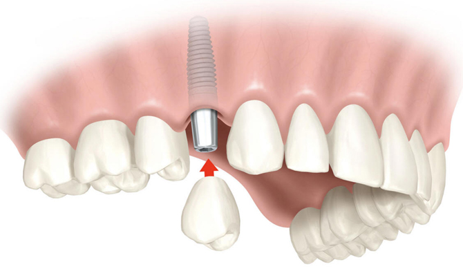 зубной имплант