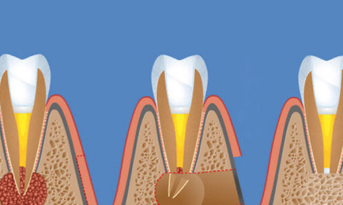 Резекция верхушки корня зуба